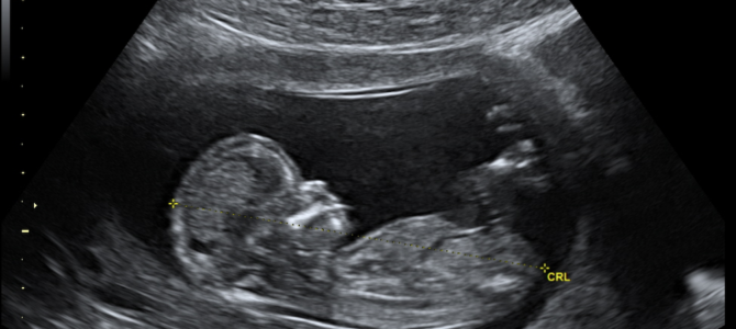 abortion baby ultrasound
