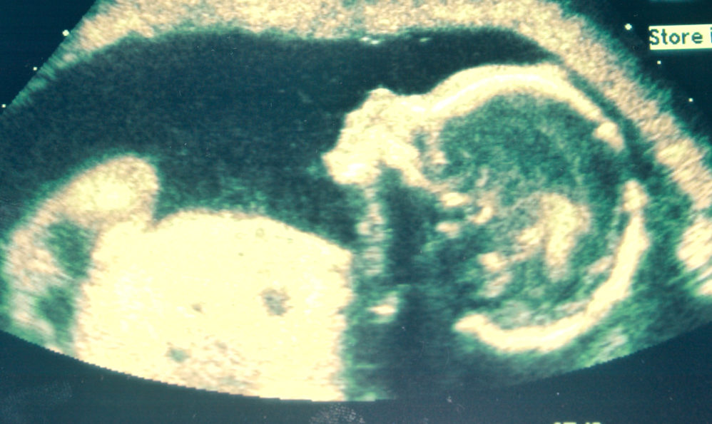 Let’s Celebrate The Best Year In Decades For The Preborn’s Right To Life