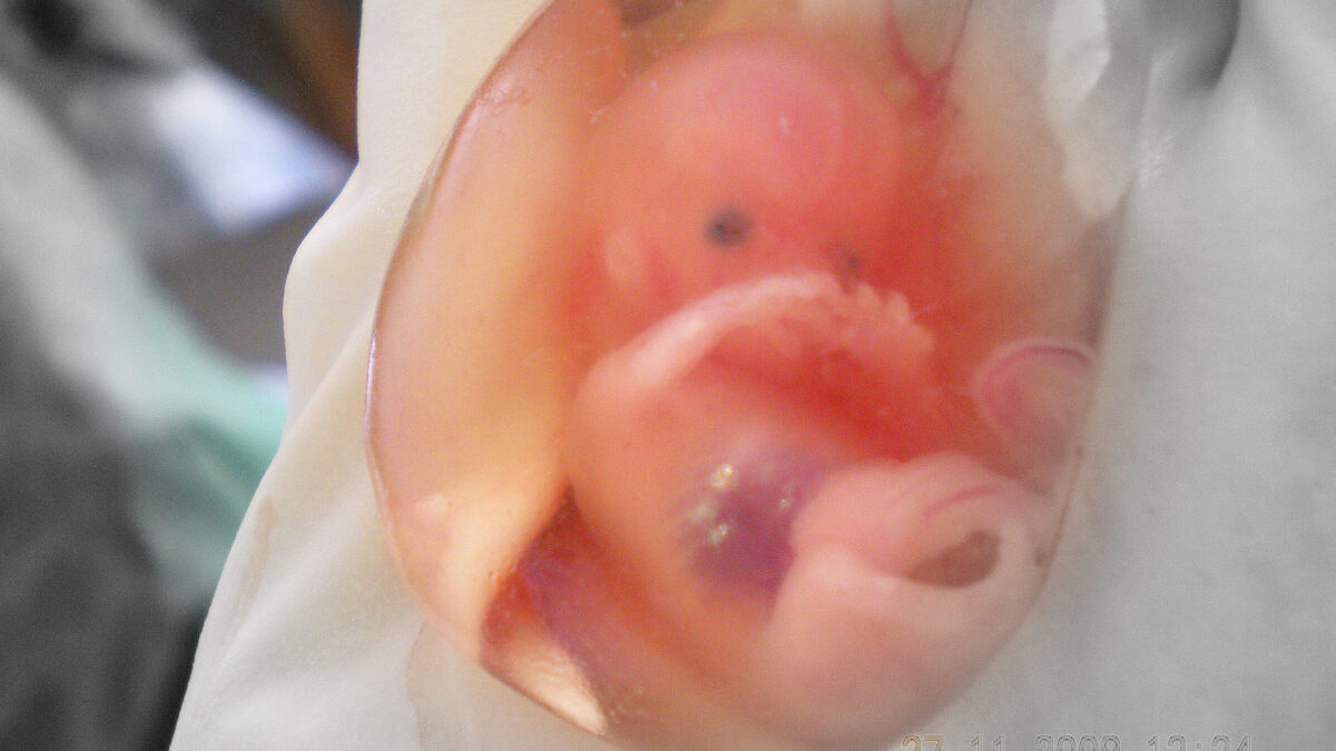 fetus