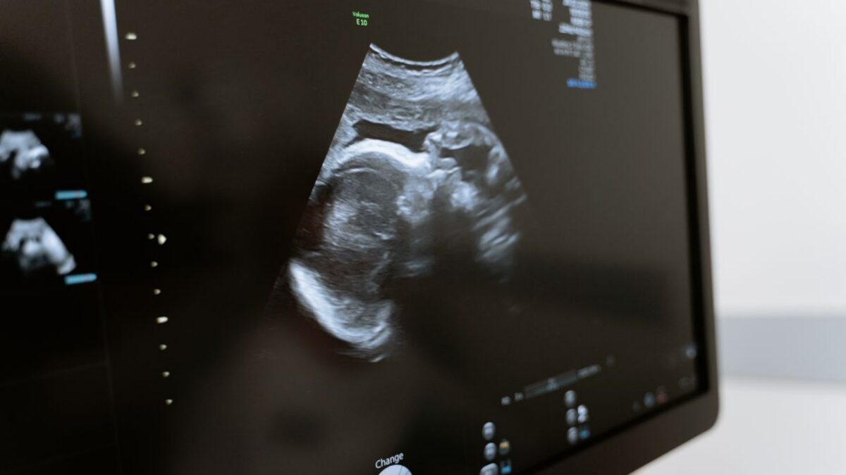 Ultrasound of baby.